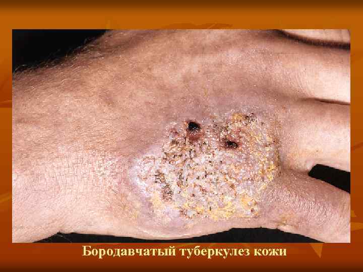 Бородавчатый туберкулез кожи 