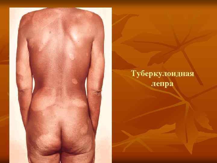 Туберкулоидная лепра 