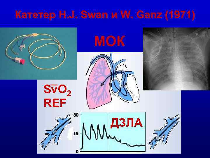 Катетер H. J. Swan и W. Ganz (1971) МОК Sv. O 2 REF ДЗЛА