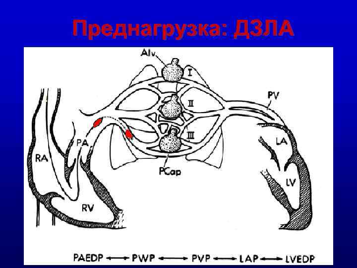 Преднагрузка: ДЗЛА 