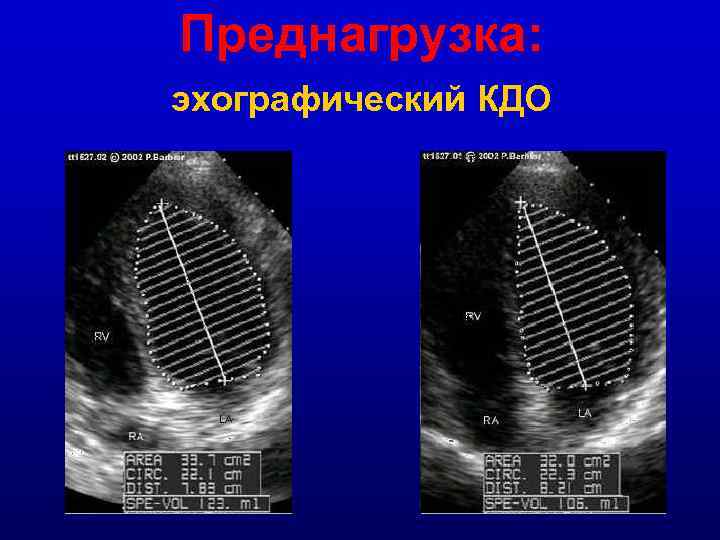 Преднагрузка: эхографический КДО 