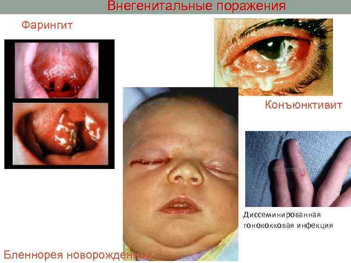 Внегенитальные поражения Фарингит Конъюнктивит Диссеминированная гонококковая инфекция Бленнорея новорожденных 