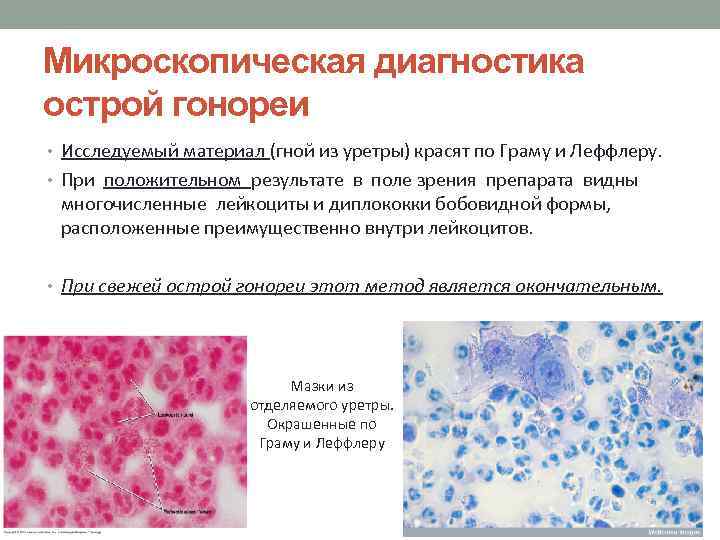 Микроскопическая диагностика острой гонореи • Исследуемый материал (гной из уретры) красят по Граму и