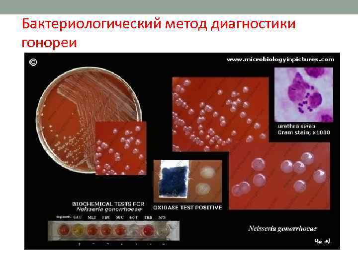 Бактериологический метод диагностики гонореи 