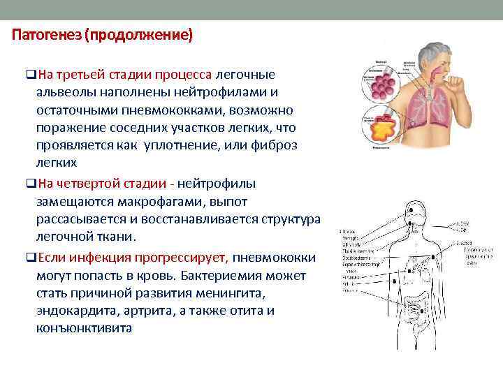  Патогенез (продолжение) q. На третьей стадии процесса легочные альвеолы наполнены нейтрофилами и остаточными