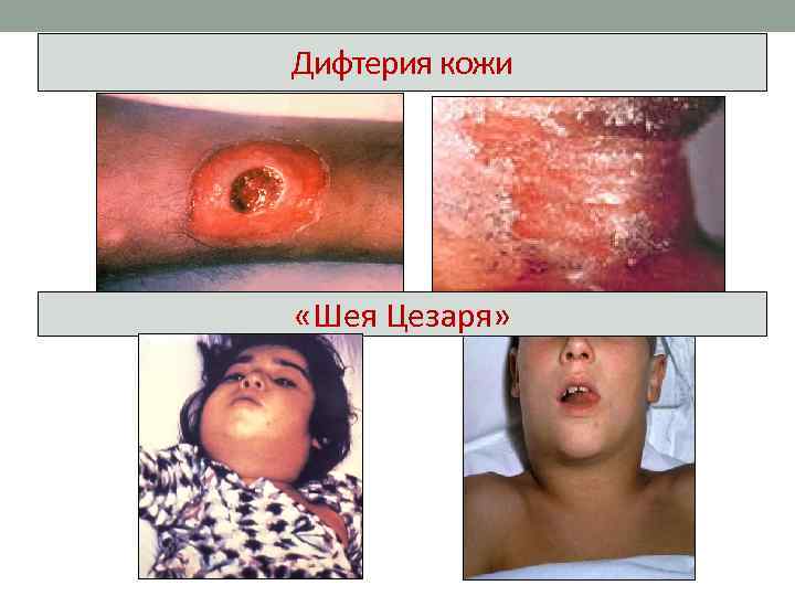 Дифтерия кожи «Шея Цезаря» 