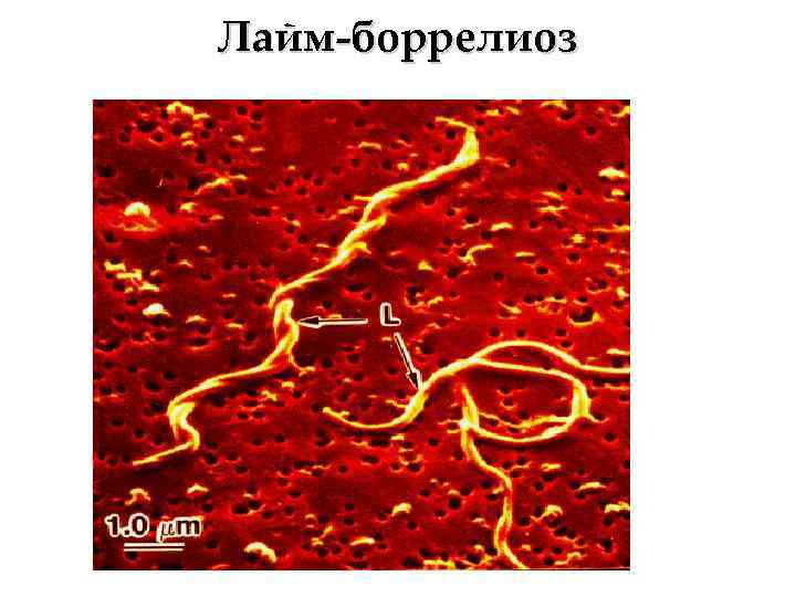 Лайм-боррелиоз 