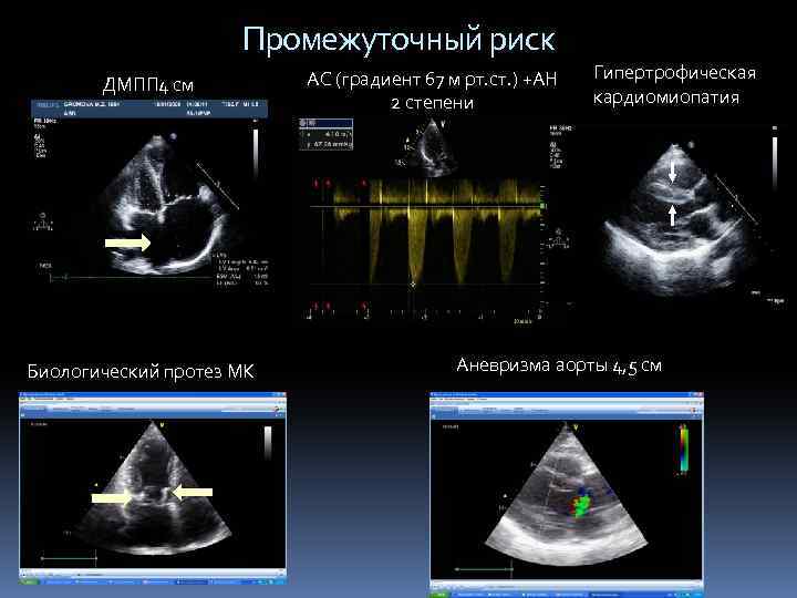 Промежуточный риск ДМПП 4 см Биологический протез МК АС (градиент 67 м рт. ст.