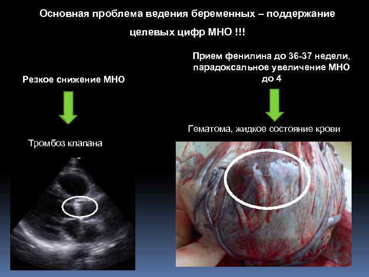 Основная проблема ведения беременных – поддержание целевых цифр МНО !!! Резкое снижение МНО Прием