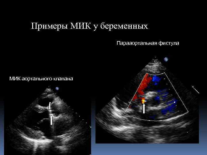Примеры МИК у беременных Парааортальная фистула МИК аортального клапана 