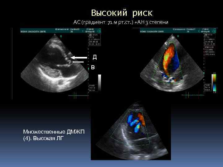 Высокий риск АС (градиент 71 м рт. ст. ) +АН 3 степени Д В