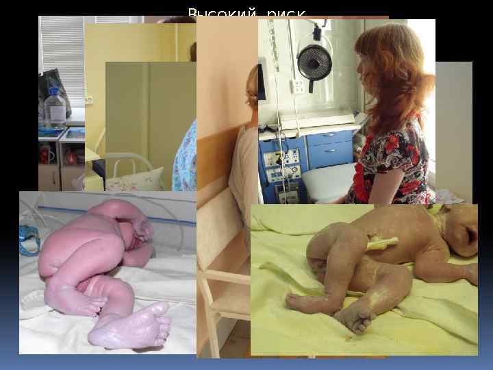 Высокий риск Синдром Марфана 