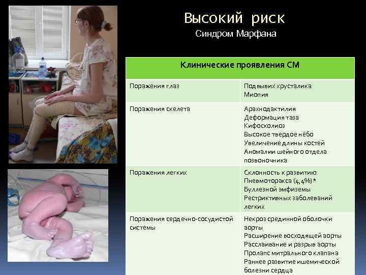 Высокий риск Синдром Марфана Клинические проявления СМ Поражения глаз Подвывих хрусталика Миопия Поражения скелета