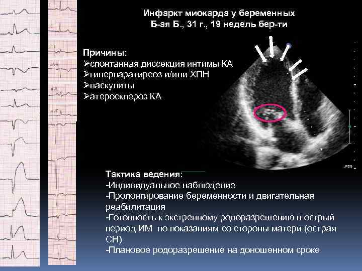 Инфаркт миокарда у беременных Б-ая Б. , 31 г. , 19 недель бер-ти Причины: