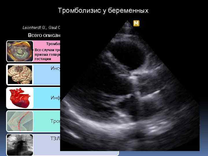 Тромболизис у беременных Thrombolytic therapy in pregnancy. Leonhardt G. , Gaul C. , Nietsch