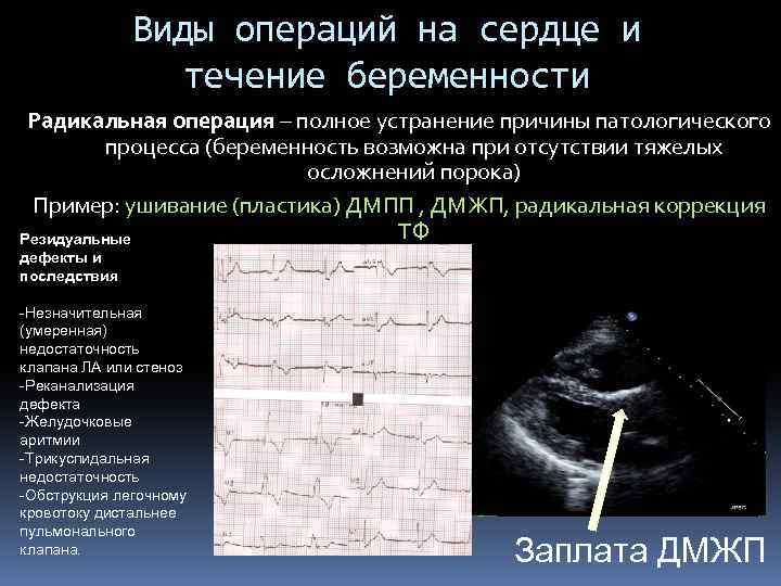 Виды операций на сердце и течение беременности Радикальная операция – полное устранение причины патологического