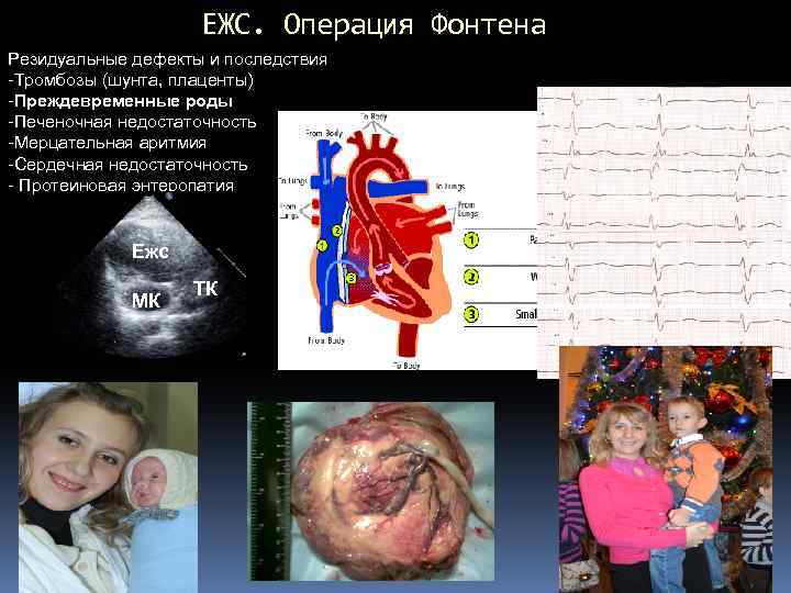 ЕЖС. Операция Фонтена Резидуальные дефекты и последствия -Тромбозы (шунта, плаценты) -Преждевременные роды -Печеночная недостаточность