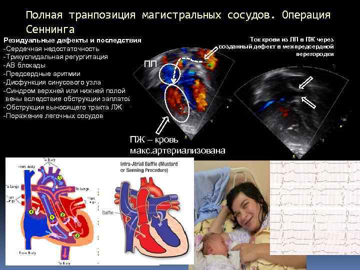 Операция сеннинга схема