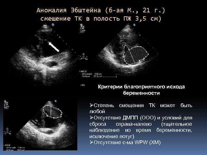 Аномалия эбштейна фото