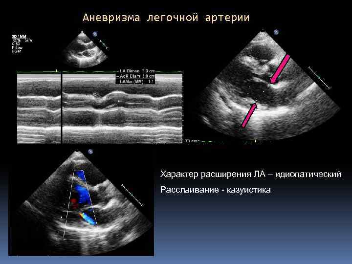 Аневризма легочной артерии Характер расширения ЛА – идиопатический Расслаивание - казуистика 