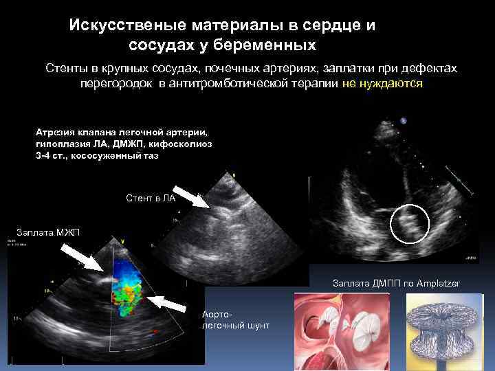 Искусственые материалы в сердце и сосудах у беременных Стенты в крупных сосудах, почечных артериях,