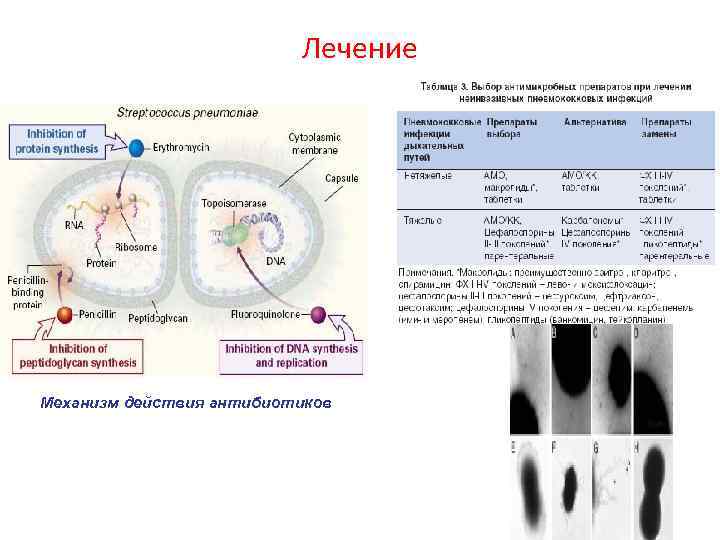  Лечение Механизм действия антибиотиков 