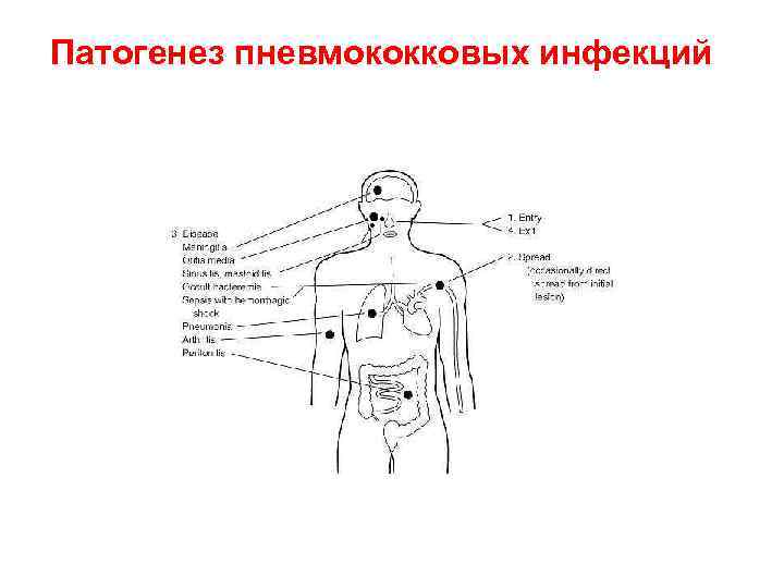 Патогенез пневмококковых инфекций 