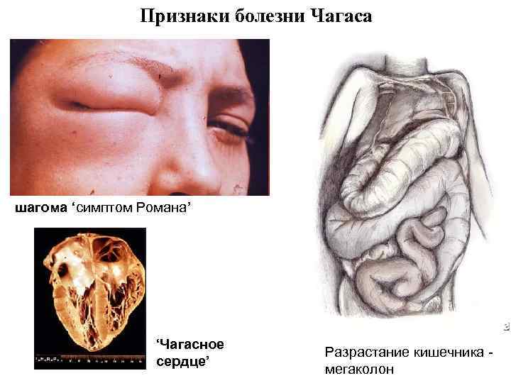  Признаки болезни Чагаса шагома ‘симптом Романа’ ‘Чагасное Разрастание кишечника - сердце’ мегаколон 