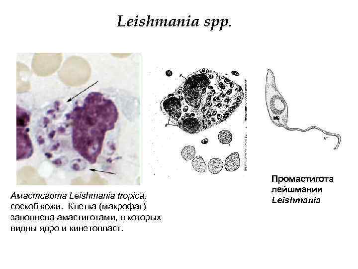  Leishmania spp. Промастигота лейшмании Амастигота Leishmania tropica, Leishmania соскоб кожи. Клетка (макрофаг) заполнена