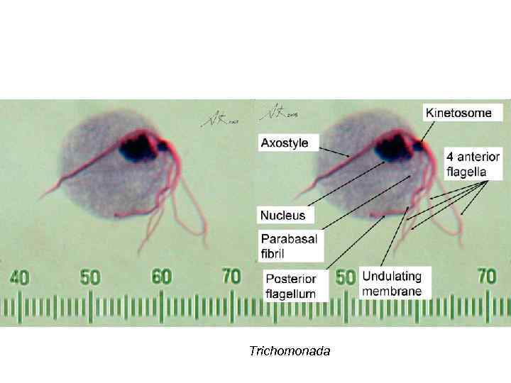 Trichomonada 