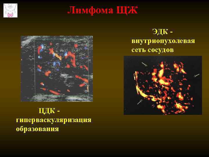 Лимфома ЩЖ ЭДК внутриопухолевая сеть сосудов ЦДК гиперваскуляризация образования 