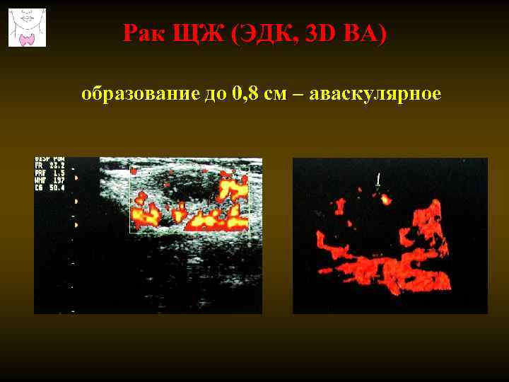 Рак ЩЖ (ЭДК, 3 D ВА) образование до 0, 8 см – аваскулярное 