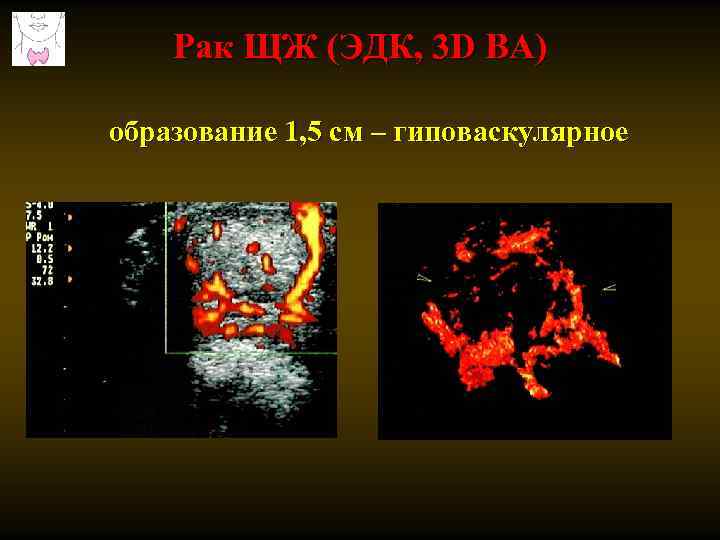 Рак ЩЖ (ЭДК, 3 D ВА) образование 1, 5 см – гиповаскулярное 