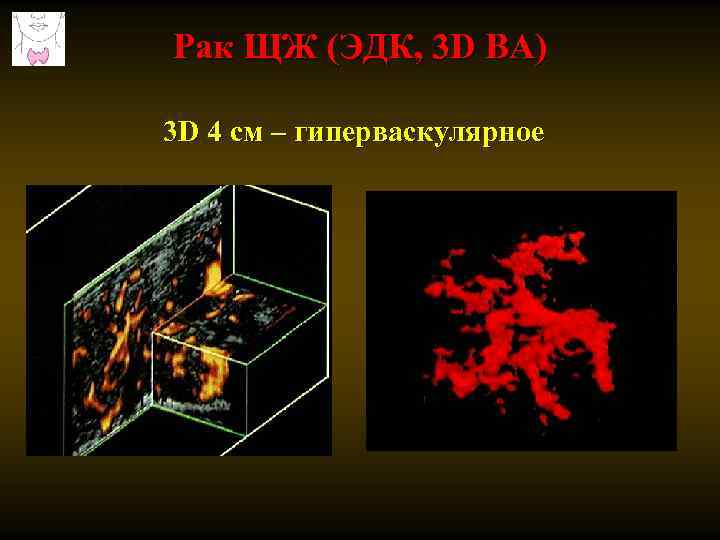 Рак ЩЖ (ЭДК, 3 D ВА) 3 D 4 см – гиперваскулярное 