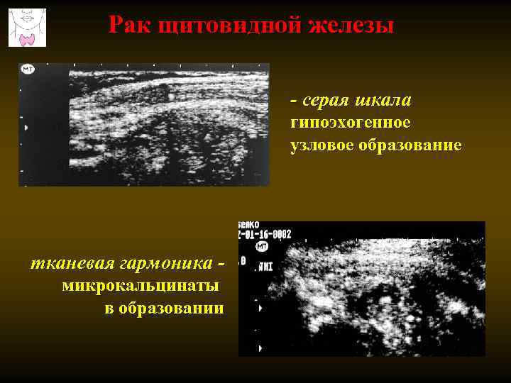 Рак щитовидной железы - серая шкала гипоэхогенное узловое образование тканевая гармоника микрокальцинаты в образовании