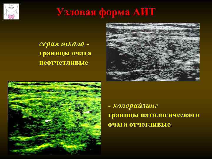 Узловая форма АИТ серая шкала границы очага неотчетливые - колорайзинг границы патологического очага отчетливые
