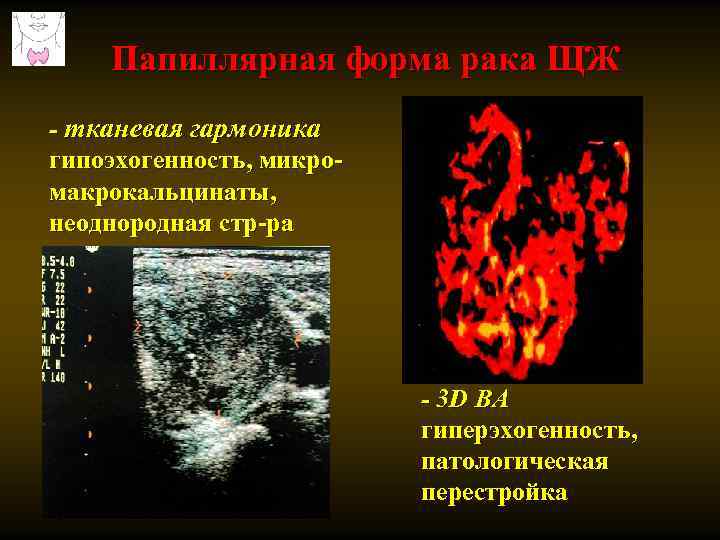 Папиллярная форма рака ЩЖ - тканевая гармоника гипоэхогенность, микромакрокальцинаты, неоднородная стр-ра - 3 D