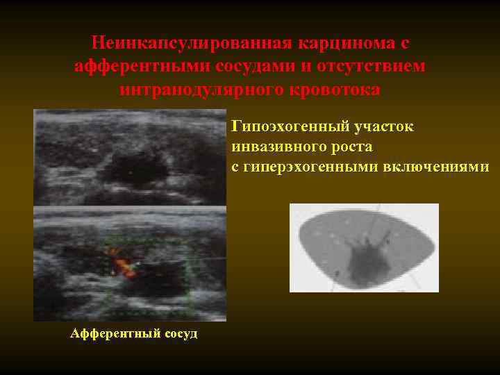 Неинкапсулированная карцинома с афферентными сосудами и отсутствием интранодулярного кровотока Гипоэхогенный участок инвазивного роста с