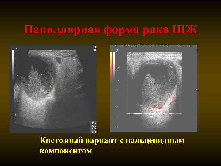 Папиллярная форма рака ЩЖ Кистозный вариант с пальцевидным компонентом 
