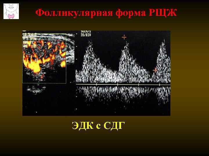 Фолликулярная форма РЩЖ ЭДК с СДГ 