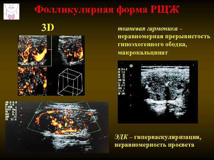 Фолликулярная форма РЩЖ 3 D тканевая гармоника – неравномерная прерывистость гипоэхогенного ободка, макрокальцинат ЭДК