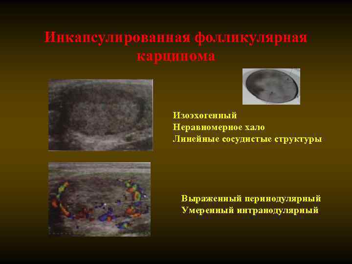 Инкапсулированная фолликулярная карцинома Изоэхогенный Неравномерное хало Линейные сосудистые структуры Выраженный перинодулярный Умеренный интранодулярный 
