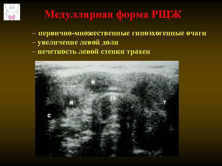 Медуллярная форма РЩЖ – первично-множественные гипоэхогенные очаги – увеличение левой доли – нечеткость левой