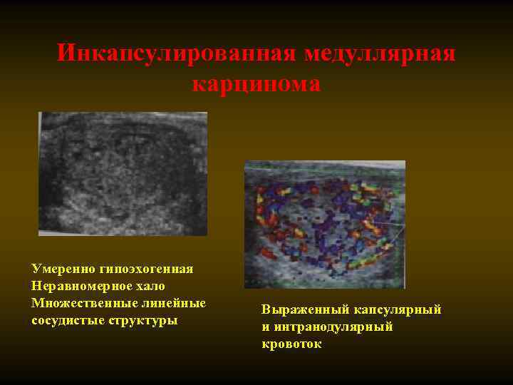 Инкапсулированная медуллярная карцинома Умеренно гипоэхогенная Неравномерное хало Множественные линейные сосудистые структуры Выраженный капсулярный и