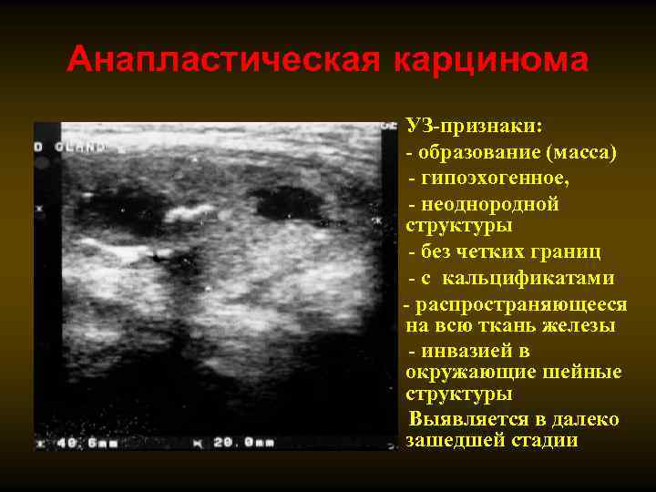 Анапластическая карцинома • УЗ-признаки: • - образование (масса) - гипоэхогенное, - неоднородной структуры -