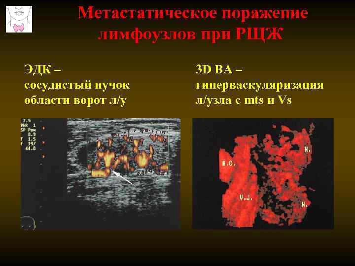 Метастатическое поражение лимфоузлов при РЩЖ ЭДК – сосудистый пучок области ворот л/у 3 D