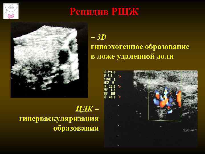 Рецидив РЩЖ – 3 D гипоэхогенное образование в ложе удаленной доли ЦДК – гиперваскуляризация