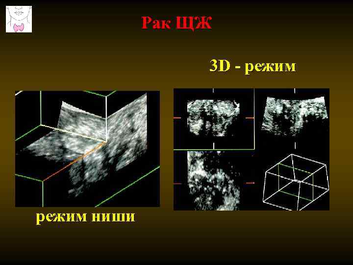 Рак ЩЖ 3 D - режим ниши 