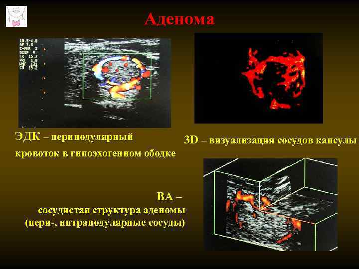 Аденома ЭДК – перинодулярный 3 D – визуализация сосудов капсулы кровоток в гипоэхогенном ободке