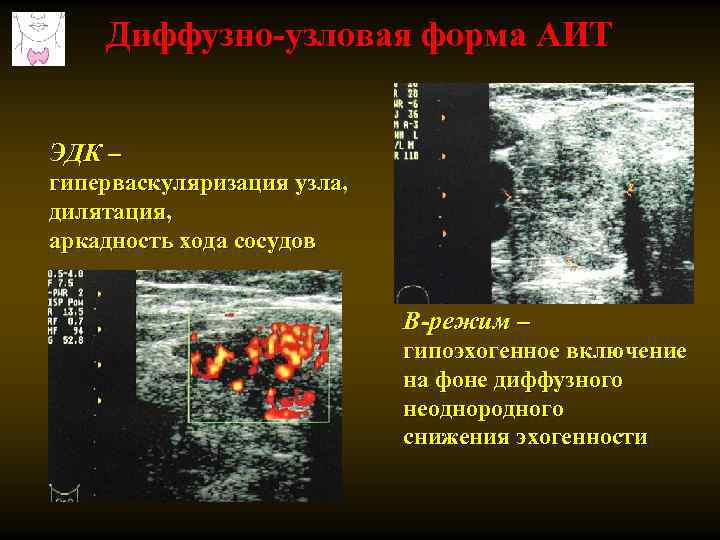 Диффузно-узловая форма АИТ ЭДК – гиперваскуляризация узла, дилятация, аркадность хода сосудов В-режим – гипоэхогенное